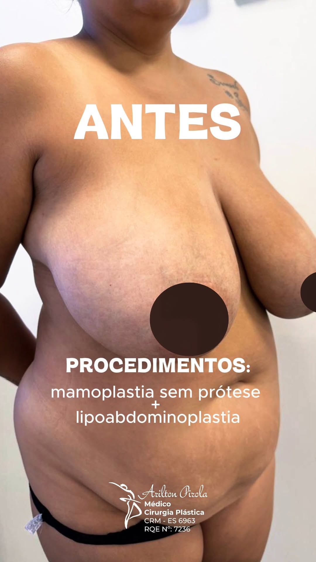 Antes e depois — vídeo 2