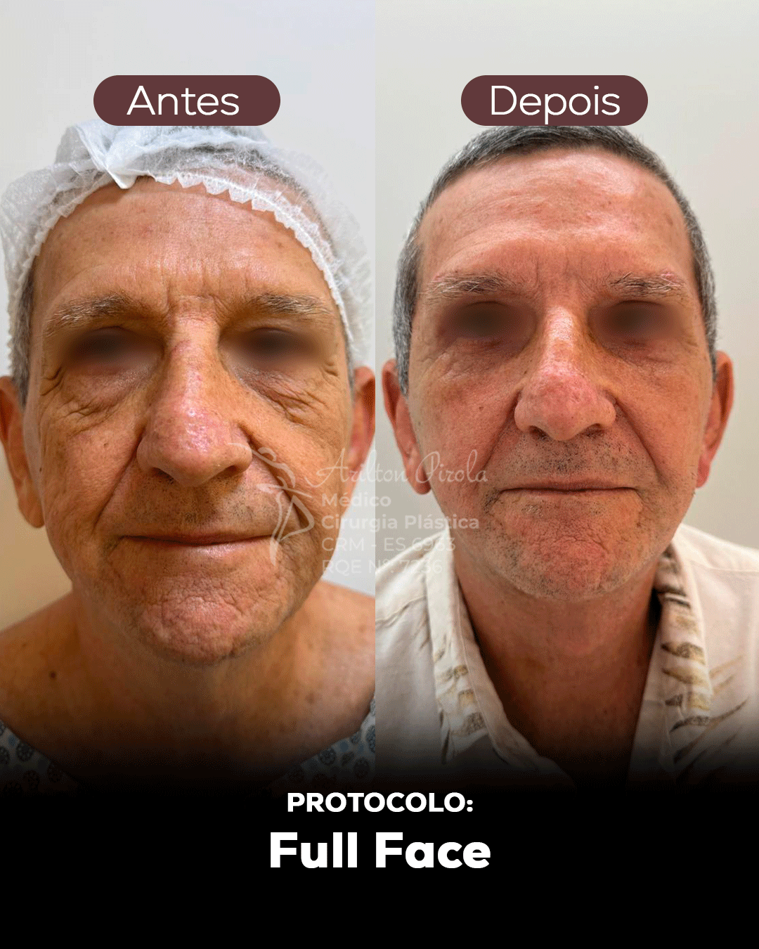 Antes e depois 2
