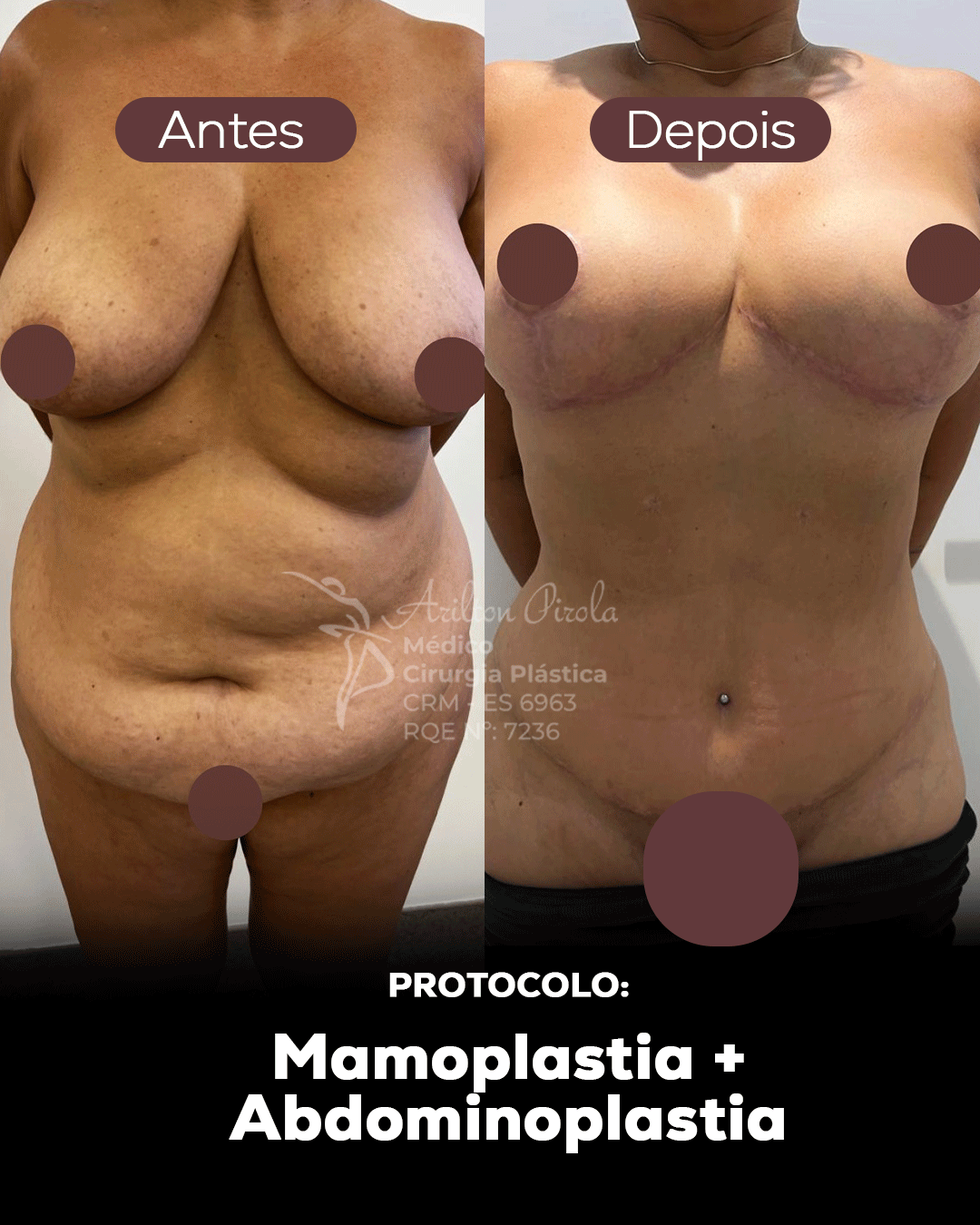 Antes e depois 3